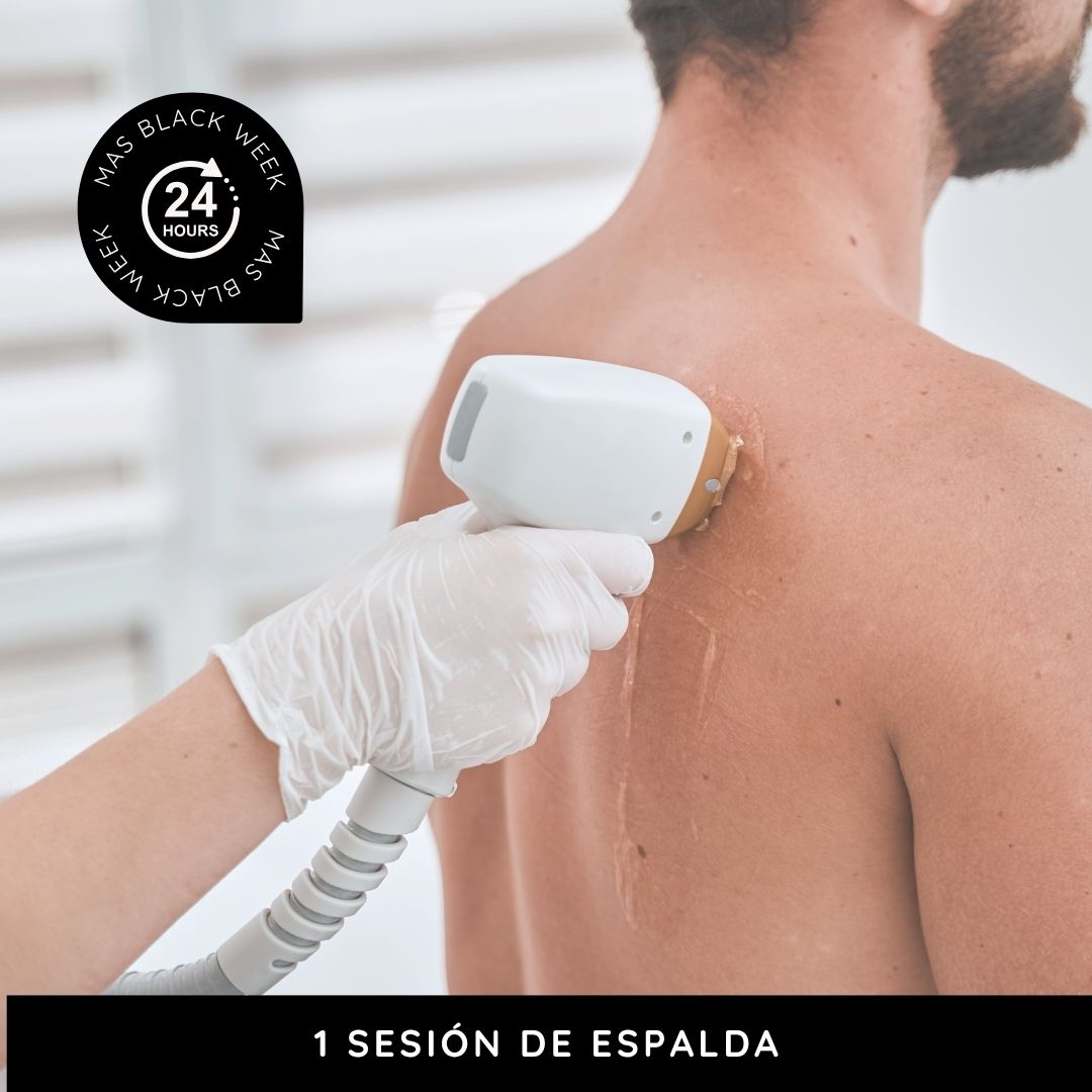 LÁSER 1 sesión de espalda